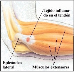 Tratamiento para la
epicondilitis o codo de tenista